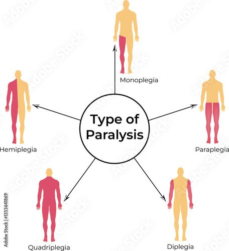 Types of Paralysis Hemiplegia Monoplegia Quadriplegia Paraplegia and Diplegia Vector Illustration