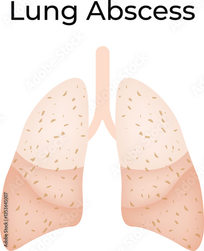 Lung Abscess An Illustration of a Pulmonary Infection
