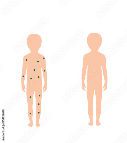 the body of a healthy child and the body of a child with chickenpox,
