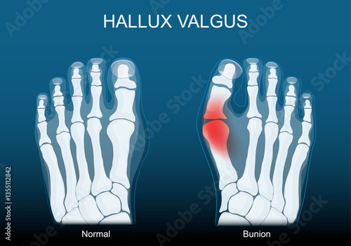 Bunion. Hallux valgus. Foot deformity