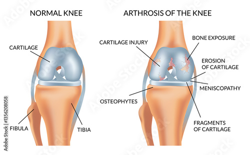 Obraz na płótnie Knee arthrosis. Healthy knee and sore knee with damaged structure. Bone exposure damaged and healthy knee structure comparison. Medical poster with foot bones. Isolated illustration w salonie