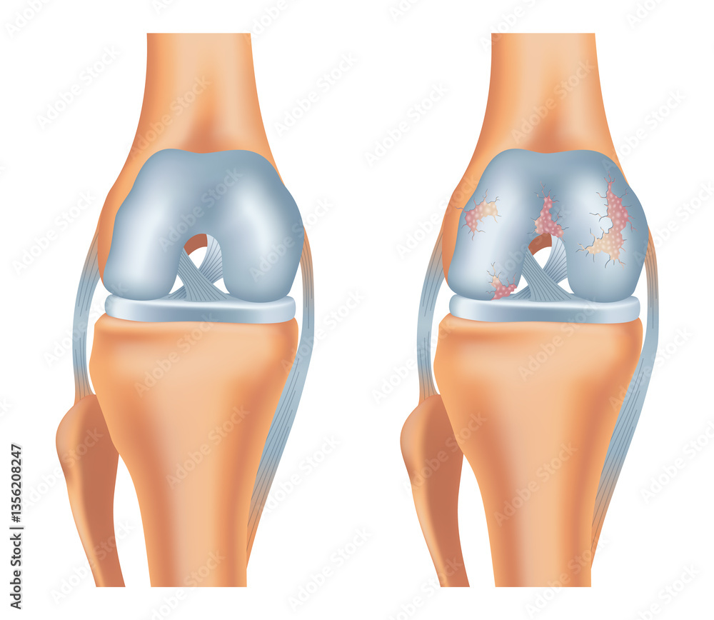 Knee arthrosis. Healthy knee and sore knee with damaged structure. Bone exposure damaged and healthy knee structure comparison. Medical poster with foot bones. Isolated illustration