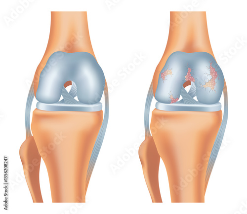 Obraz na płótnie Knee arthrosis. Healthy knee and sore knee with damaged structure. Bone exposure damaged and healthy knee structure comparison. Medical poster with foot bones. Isolated illustration w salonie