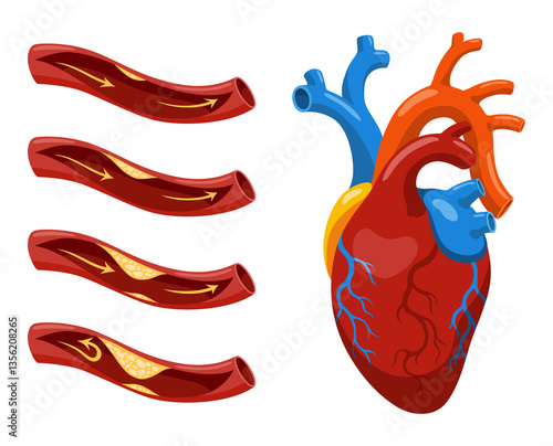 Atherosclerosis stages. Anatomy of heart attack. Arteriosclerotic vascular disease or ASVD. Atherosclerotic plaque in coronary artery. illustration on white background