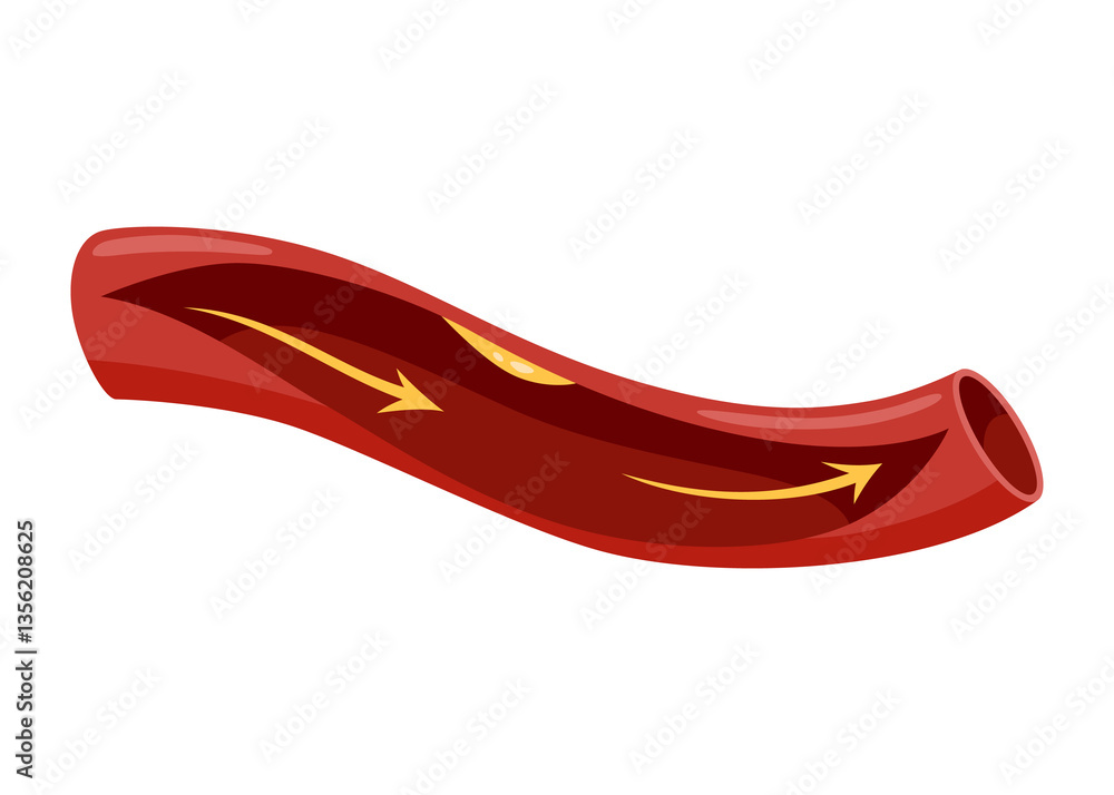Atherosclerosis stage. Anatomy of heart attack. Arteriosclerotic vascular disease or ASVD. Atherosclerotic plaque in coronary artery. illustration on white background
