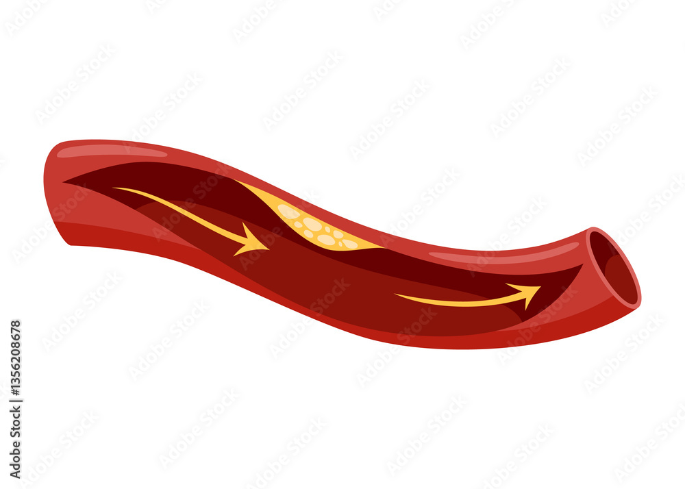 Atherosclerosis stage. Anatomy of heart attack. Arteriosclerotic vascular disease or ASVD. Atherosclerotic plaque in coronary artery. illustration on white background