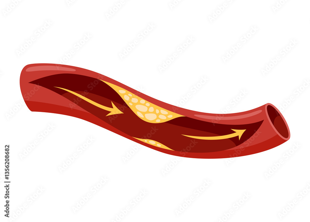 Atherosclerosis stage. Anatomy of heart attack. Arteriosclerotic vascular disease or ASVD. Atherosclerotic plaque in coronary artery. illustration on white background