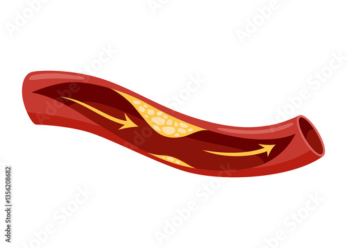 Obraz na płótnie Atherosclerosis stage. Anatomy of heart attack. Arteriosclerotic vascular disease or ASVD. Atherosclerotic plaque in coronary artery. illustration on white background w salonie