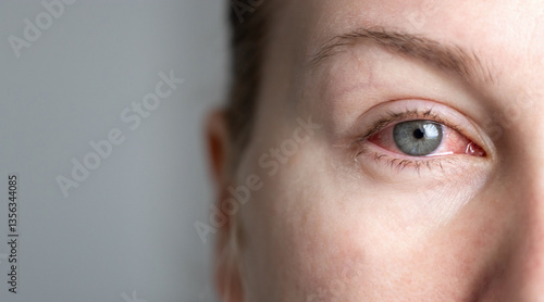Close up of female face with one red eye suffering from infection conjunctivitis