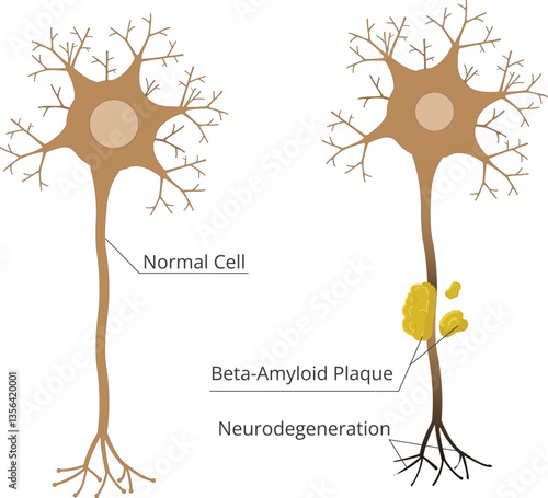 Normal cell vs neuron affected by neurodegeneration. Pathophysiology of Alzheimer's disease, with amyloid plaques damaging neural cell vector
