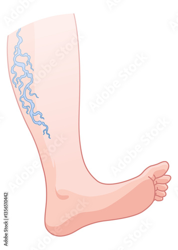 Obraz na płótnie Varicose veins. Blue blood vessel visible through the skin, abnormally swollen leg. Vascular disease diagnostic and treatment. Venous insufficiency medical disease w salonie