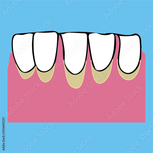 receding gums disease dentist  teeth disease 