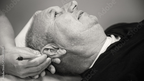 Obraz na płótnie Dry needling with very fine needles inserted in target locations on the human ear w salonie