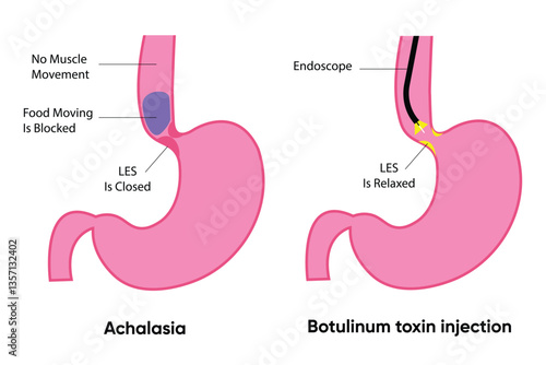 Achalasia and Botulinum Toxin Injection – Medical Illustration of Esophageal Disorder Treatment