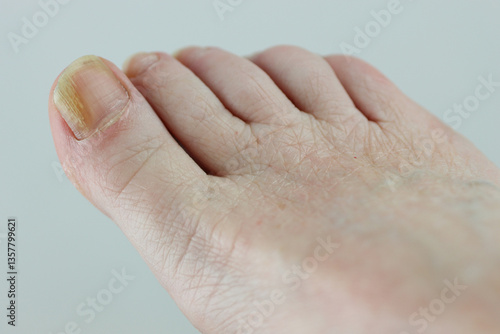 Εκτύπωση καμβά close up of a foot with toenail fungus on the big toe