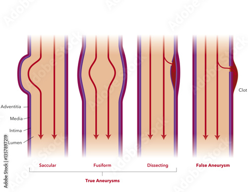 Types of True and False Aneurysms