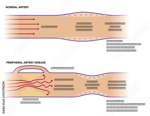 Peripheral Artery Disease