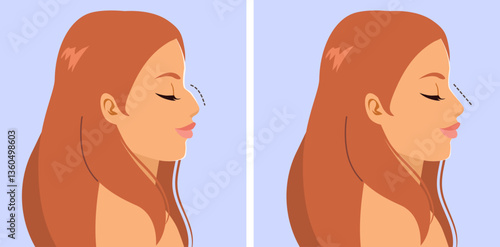 Detailed cartoon illustration showing woman nose profile before and after rhinoplasty surgery. Drawing for cosmetic surgery clinics, beauty blogs, health-related content