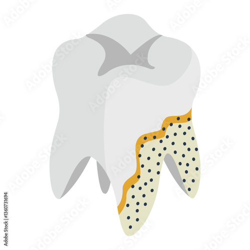 Periapical Abscess isometric concept, Tartar and Plaque effect tooth vector icon design, Dentures symbol,Oral Healthcare sign, Dental instrument illustration