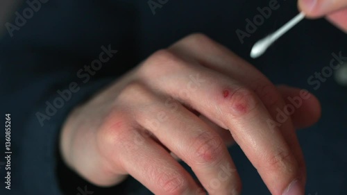 A man treats an injured hand with a cotton swab.
Close-up of a cotton swab.
Antibacterial procedures.
Hand injury