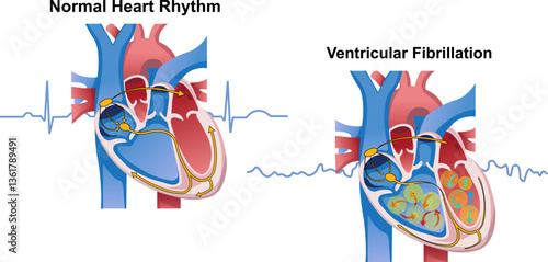 Normal heart rhythm vs ventricular fibrillation