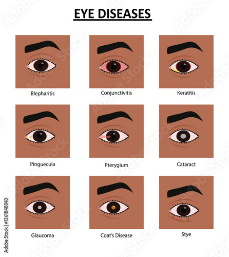 Eye diseases vector illustration