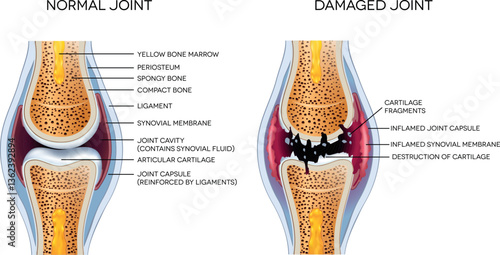 Damaged joint and healthy joint detailed diagram