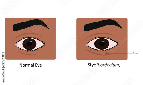 Stye(hordeolum) eye disease vector illustration