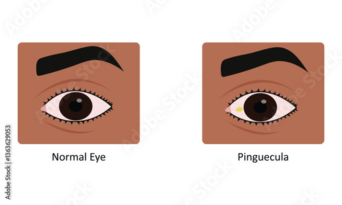 Pinguecula eye disease vector illustration