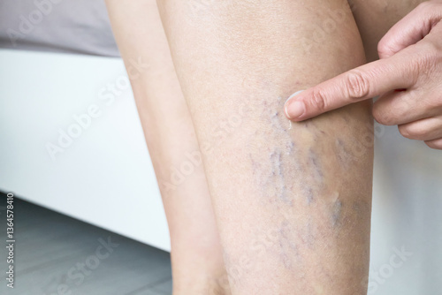 Bild auf Leinwand Woman sits on bed and applies cream to her legs with varicose veins close-up