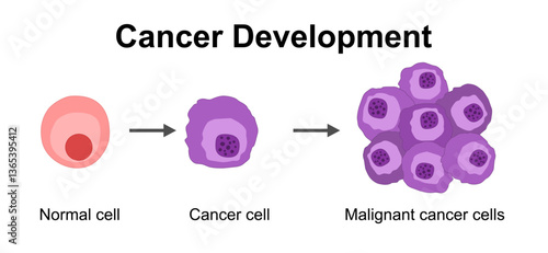 Cancer development. Normal cells are transformed into cancer. Carcinogenesis from Genetic mutations in healthy cell to Malignant cancer cells. Mutagenesis, Oncogenesis, tumorigenesis. Tumor formation