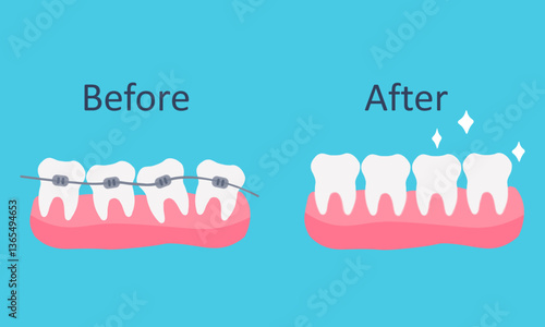 Stages of teeth alignment, before and after correction with brackets Correction of teeth with orthodontic braces Vector illustration on blue background