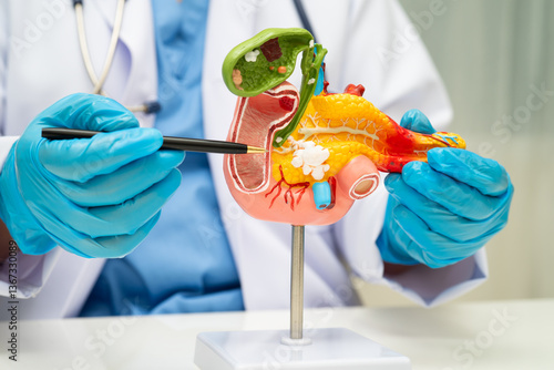 Cuadro en lienzo Pancreatitis, pancreatic cancer, Asian doctor with pancreas, gallbladder and bile duct human anatomy model at hospital