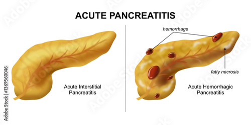 Acute Pancreatitis Hemorrhagic, fatty necrosis pancreas illustration