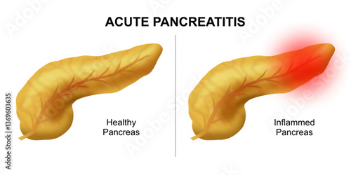 Acute Pancreatitis Inflammed pancreas illustration