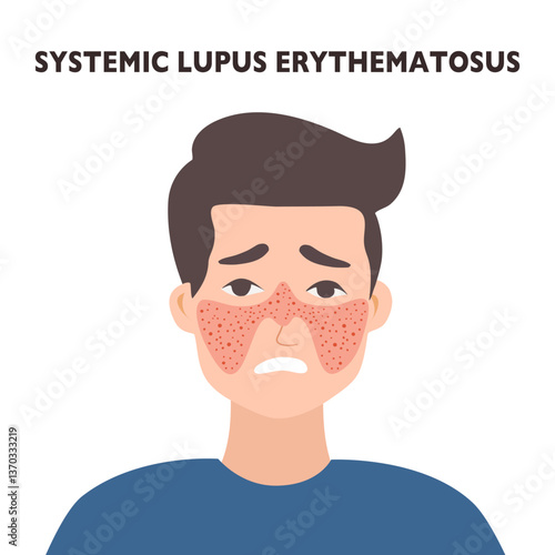 systemic lupus erythematosus. Young man with the typical butterfly rash in lupus. SLE. skin disease