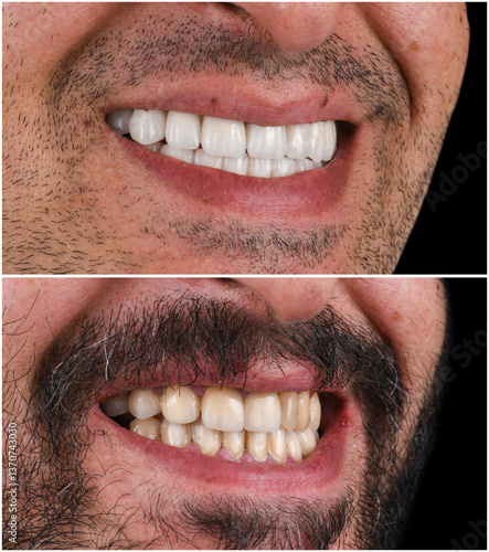 emax ceramic veneers