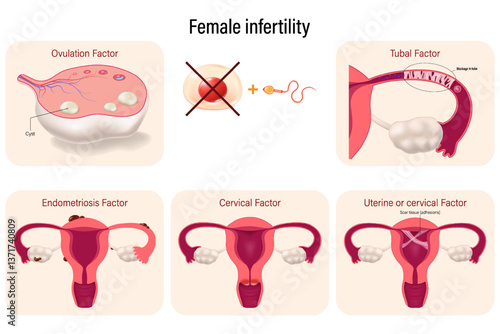 Female infertility. Causes of infertility in women. Ovulation, tubal, endometiosis, cervical and uterine factor. Female reproductive system.