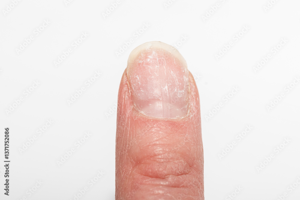 Fototapeta premium Close-up of a damaged fingernail with peeling and brittle surface on a white background. Concept of nail health, injury, and care. Mechanical nail damage. bad habits. nail health on hormonal balance