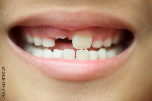 Close up of a child's mouth with new teeth