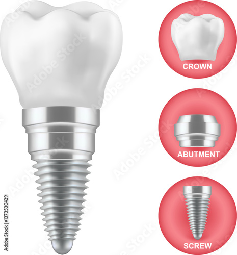 Dental implant. Realistic implant structure, graphic models of the crown. Screw prosthesis,Illustration of tooth implantation ,orthodontic dental implantation