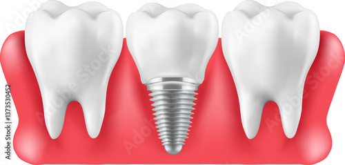 Illustration of tooth implantation, tooth restoration, Mesh gradient wes