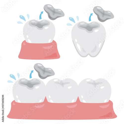 詰め物が取れる歯のイラストセット