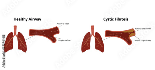 Cystic fibrosis vector illustration