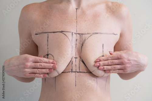 woman patient with medical surgical marks drawn on chest for plastic surgery preparation, medical mammoplasty, mastopexy breast enlargement, on white background