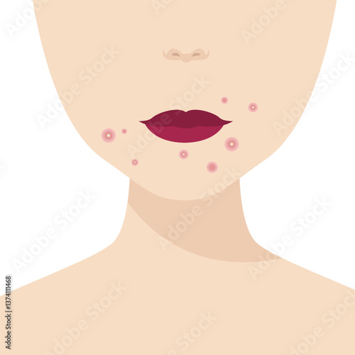 Young girl has skin problems with acne or allergic pimples on her face. Skincare and dermatology concept. Flat style vector illustration.