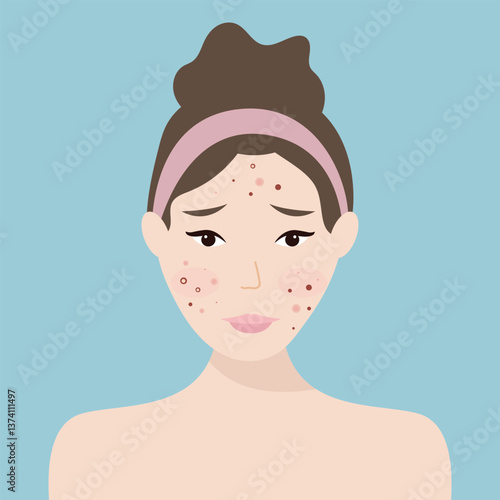 Young girl has skin problems with acne or allergic pimples on her face. Skincare and dermatology concept. Flat style vector illustration.