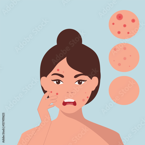 Young girl has skin problems with acne or allergic pimples on her face. Skincare and dermatology concept. Flat style vector illustration.