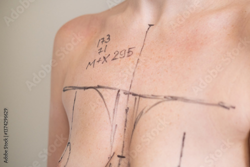 Plastic surgeon marking womans breast with pen before surgery, patient standing topless while doctor draws incision lines on chest, medical aesthetic procedure, medical mammoplasty, mastopexy 