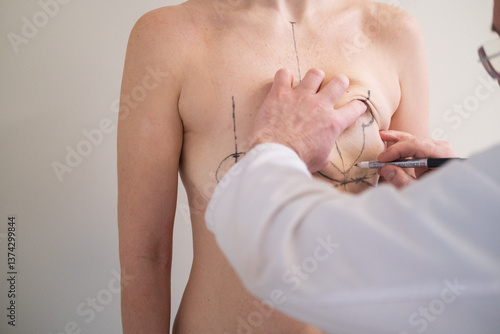 Plastic surgeon marking womans breast with pen before surgery, patient standing topless while doctor draws incision lines on chest, medical aesthetic procedure, medical mammoplasty, mastopexy 